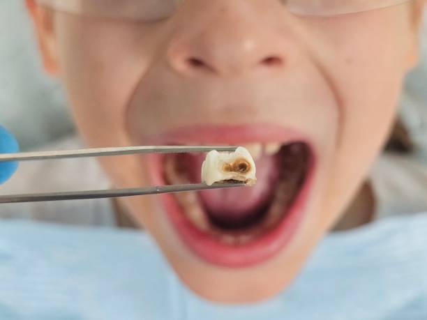 Best Emergency Dental Care for Broken or Chipped Teeth in Effingham, IL